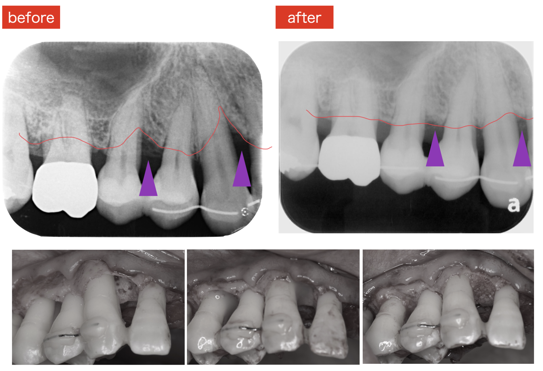 【治療例】歯周組織再生療法で歯周病で失った骨を再生させた症例①