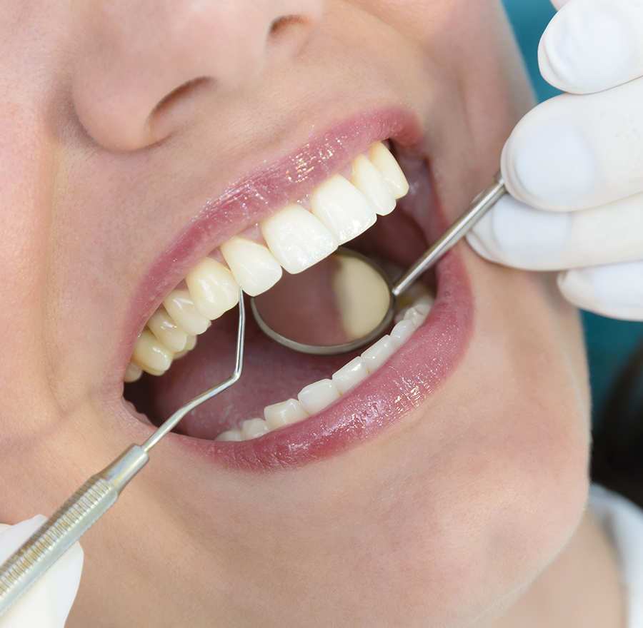 虫歯の原因を考えたことがありますか？