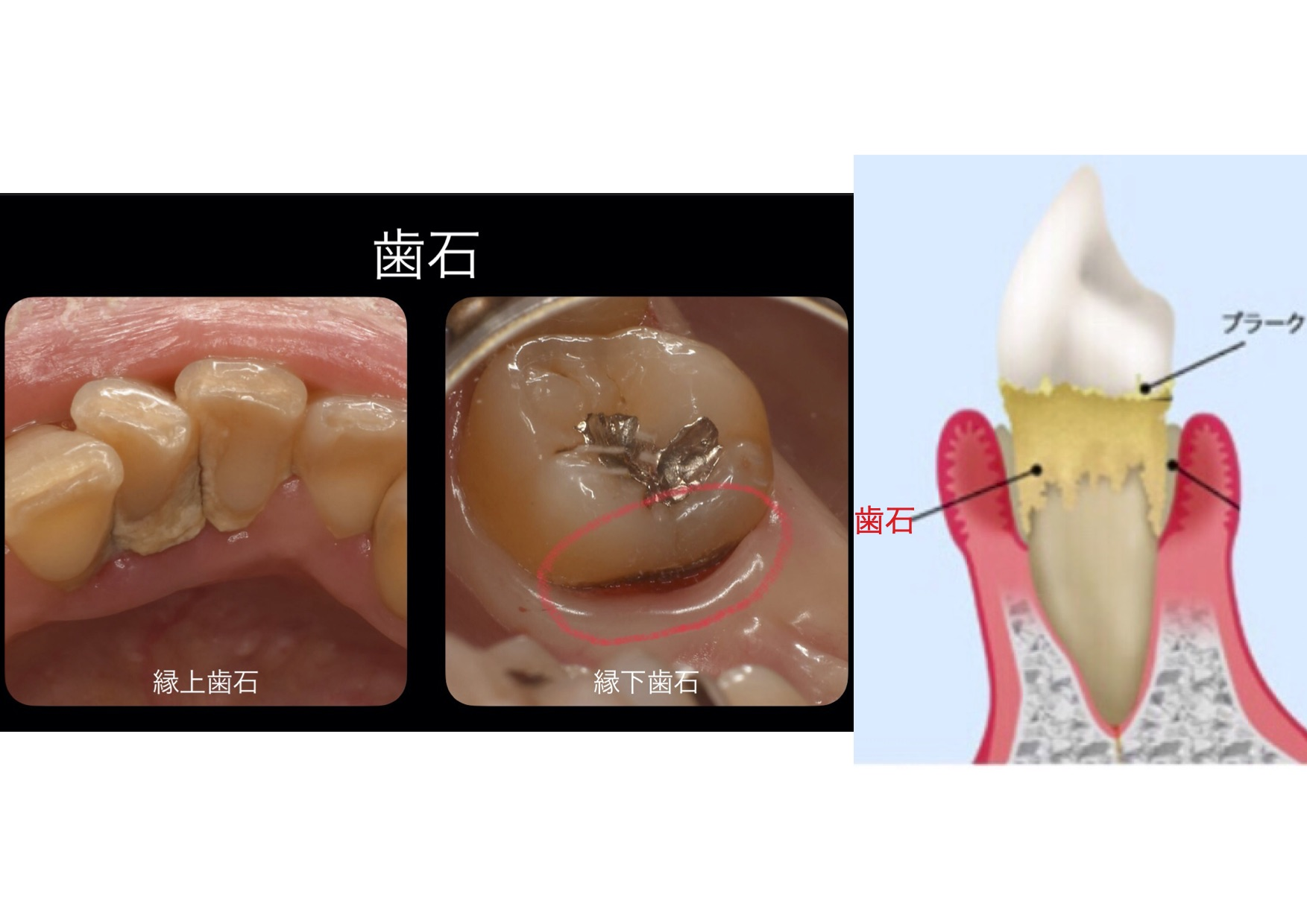 〜歯周基本治療〜